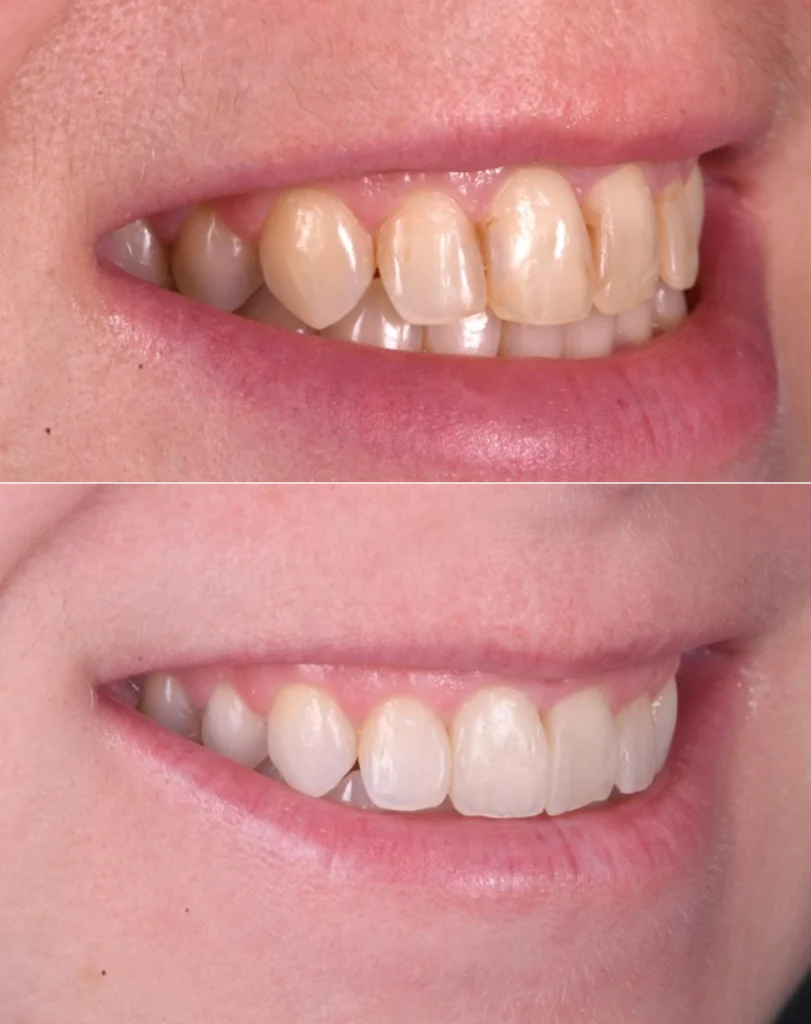 facettes gencives strasbourg facettes gencives strasbourg Des traitements esthétiques pour transformer votre sourire Dentiste Orangerie, Strasbourg | Esthétique & Implant