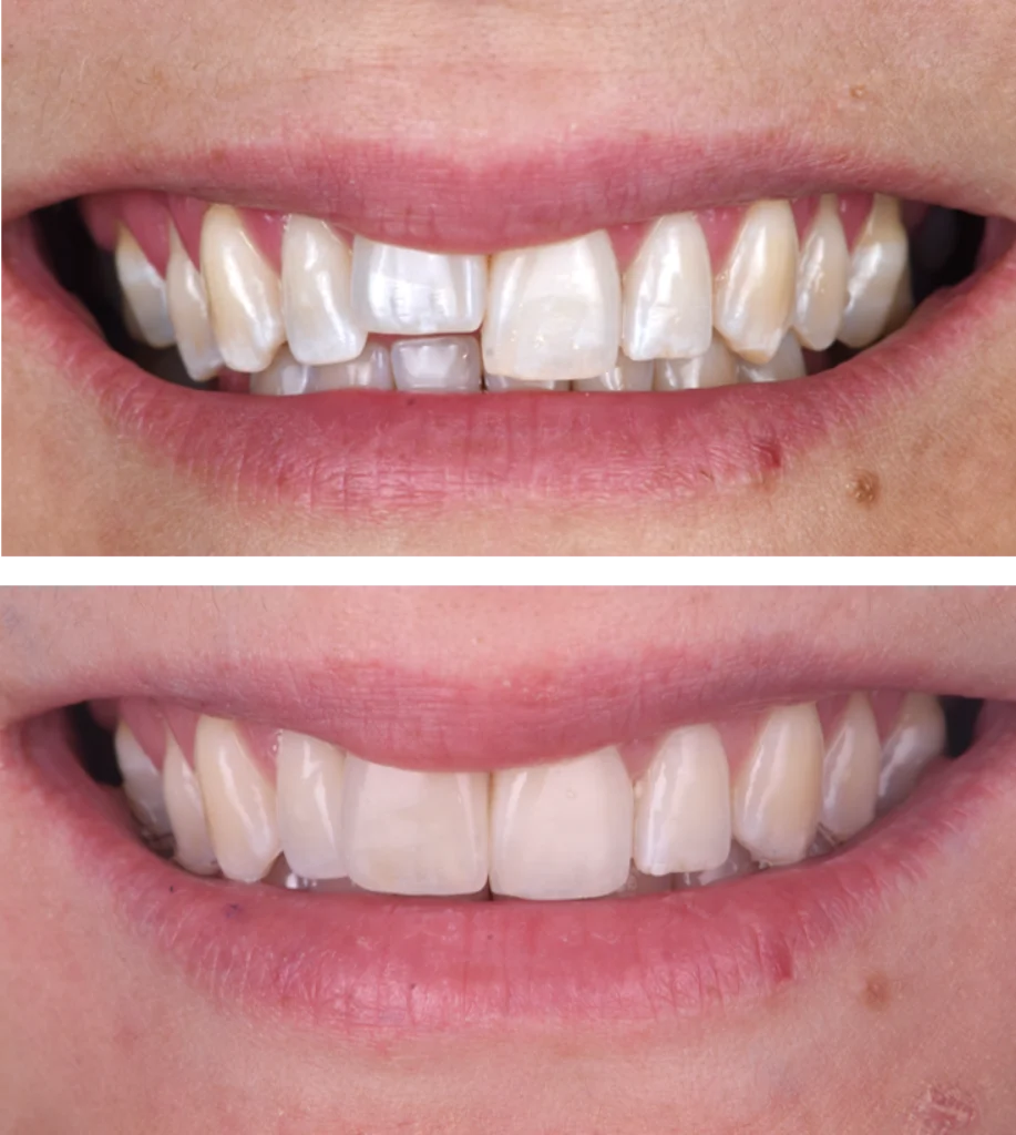 facettes implants strasbourg facettes implants strasbourg Des traitements esthétiques pour transformer votre sourire Dentiste Orangerie, Strasbourg | Esthétique & Implant