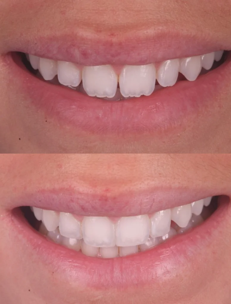 facettes personnalisees strasbourg facettes personnalisees strasbourg Des traitements esthétiques pour transformer votre sourire Dentiste Orangerie, Strasbourg | Esthétique & Implant