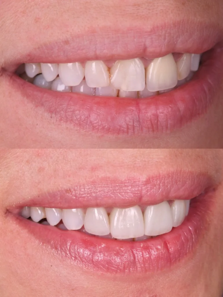 facettes restauration strasbourg facettes restauration strasbourg Des traitements esthétiques pour transformer votre sourire Dentiste Orangerie, Strasbourg | Esthétique & Implant