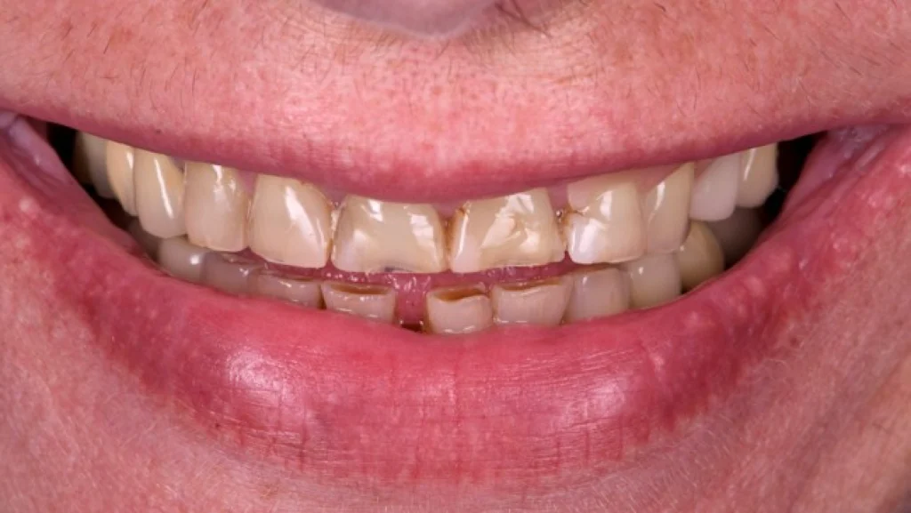 facettes retraitement strasbourg facettes retraitement strasbourg Des traitements esthétiques pour transformer votre sourire Dentiste Orangerie, Strasbourg | Esthétique & Implant