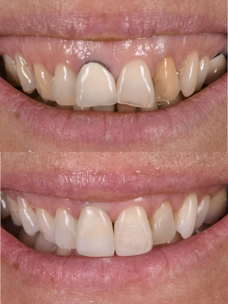 gouttiere blanchiment orangerie gouttiere blanchiment orangerie Des traitements esthétiques pour transformer votre sourire Dentiste Orangerie, Strasbourg | Esthétique & Implant