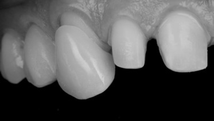 gouttiere nuit strasbourg Prothèses dentaires : une solution esthétique et fonctionnelle Dentiste Orangerie, Strasbourg | Esthétique & Implant