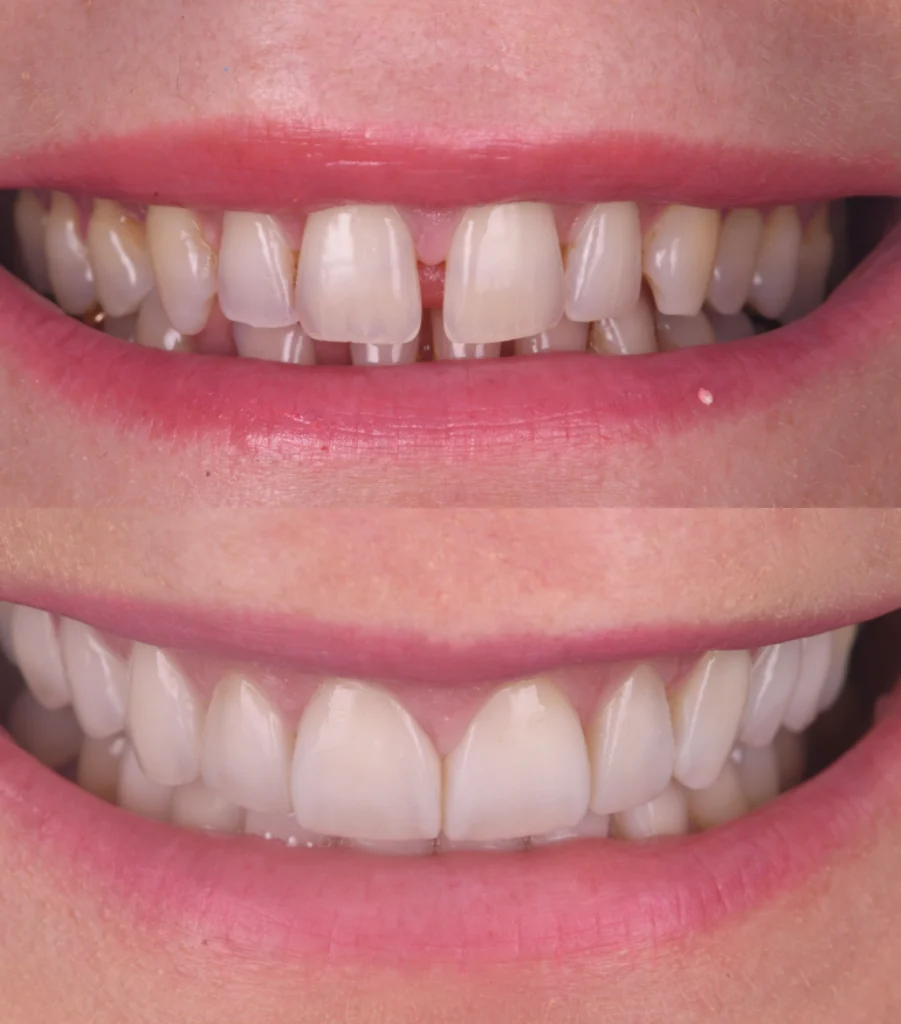 gouttiere protection strasbourg gouttiere protection strasbourg Des traitements esthétiques pour transformer votre sourire Dentiste Orangerie, Strasbourg | Esthétique & Implant
