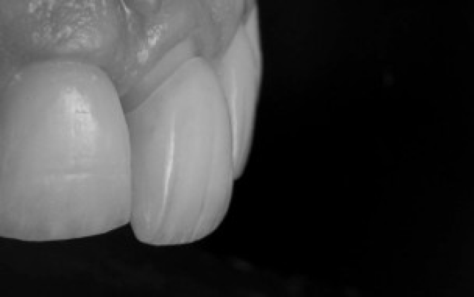 gouttiere transparente strasbourg Prothèses dentaires : une solution esthétique et fonctionnelle Dentiste Orangerie, Strasbourg | Esthétique & Implant