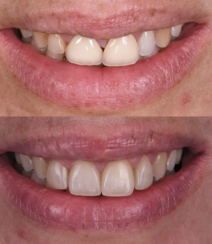 protheses dentaires solution esthetique protheses dentaires solution esthetique Des traitements esthétiques pour transformer votre sourire Dentiste Orangerie, Strasbourg | Esthétique & Implant