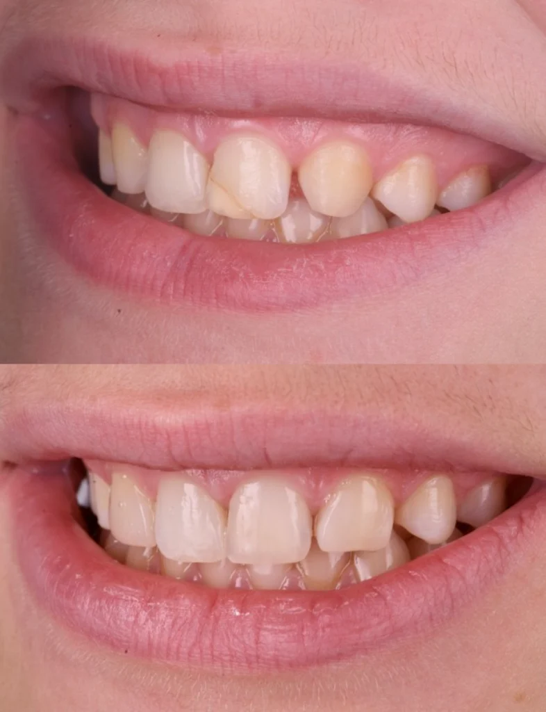 restauration sourire strasbourg restauration sourire strasbourg Des traitements esthétiques pour transformer votre sourire Dentiste Orangerie, Strasbourg | Esthétique & Implant