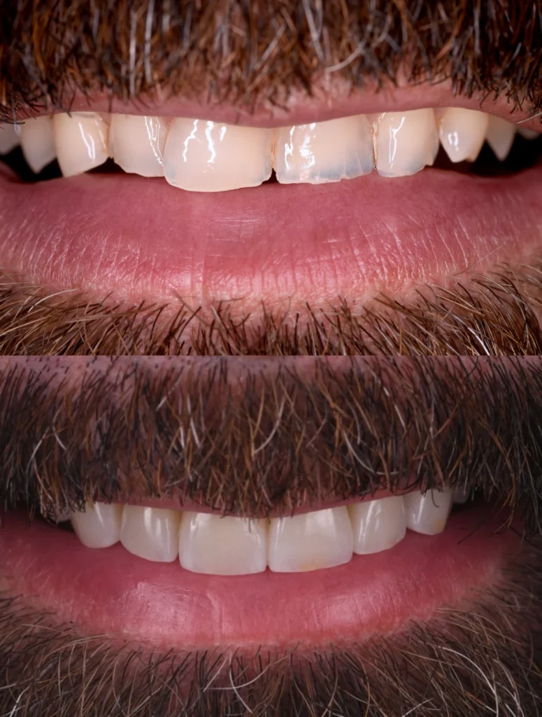 traitements esthetiques transformer sourire traitements esthetiques transformer sourire Des traitements esthétiques pour transformer votre sourire Dentiste Orangerie, Strasbourg | Esthétique & Implant
