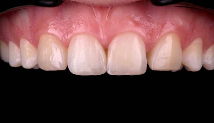 ajustement occlusion dentaire Agénésies dentaires : remplacer une dent absente dès la naissance Dentiste Orangerie, Strasbourg | Esthétique & Implant