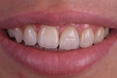 ajustement protheses dentaires ajustement protheses dentaires Agénésies dentaires : remplacer une dent absente dès la naissance Dentiste Orangerie, Strasbourg | Esthétique & Implant