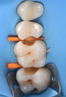 alignement dentaire technique moderne alignement dentaire technique moderne Caries, usure et érosion : préserver l’émail et la structure dentaire Dentiste Orangerie, Strasbourg | Esthétique & Implant
