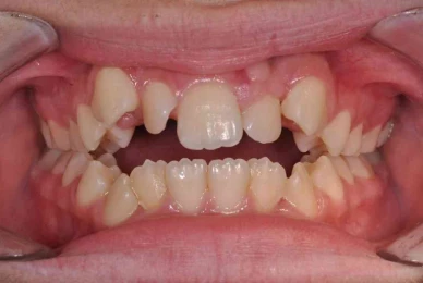 blanchiment dentaire naturel durable blanchiment dentaire naturel durable Agénésies dentaires : remplacer une dent absente dès la naissance Dentiste Orangerie, Strasbourg | Esthétique & Implant