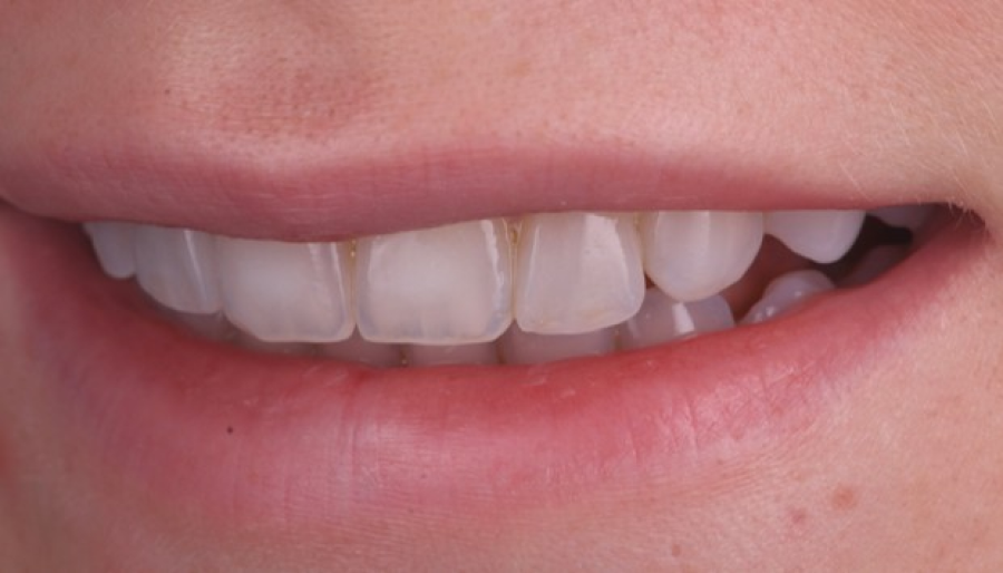 blanchiment express sourire Malformations dentaires : dents en grain de riz (riziforme) et anomalies de structure Dentiste Orangerie, Strasbourg | Esthétique & Implant