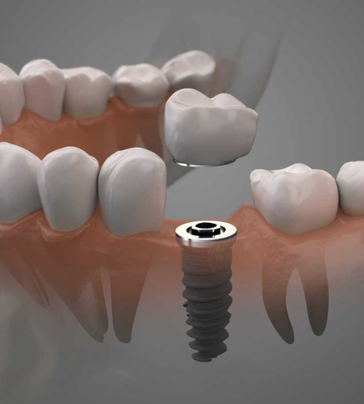Dentiste Orangerie, Strasbourg | Esthétique & Implant taches dentaires traitement strasbourg Traitement des tâches dentaires : un sourire magnifié Dentisterie esthétique : sublimez votre sourire