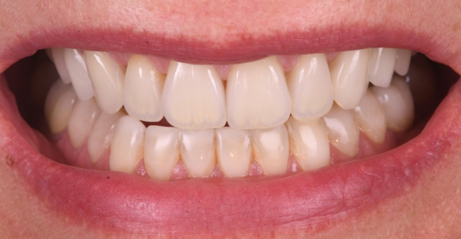 bridge provisoire dentaire Érosion dentaire : l’effet des acides sur l’émail Dentiste Orangerie, Strasbourg | Esthétique & Implant