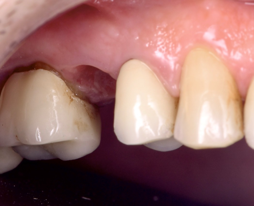 chirurgie dentaire mini invasive chirurgie dentaire mini invasive Maintien du volume gingival après extraction dentaire : anticiper pour un résultat optimal Dentiste Orangerie, Strasbourg | Esthétique & Implant