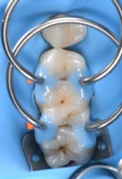 chirurgie esthetique dentaire strasbourg chirurgie esthetique dentaire strasbourg Caries, usure et érosion : préserver l’émail et la structure dentaire Dentiste Orangerie, Strasbourg | Esthétique & Implant