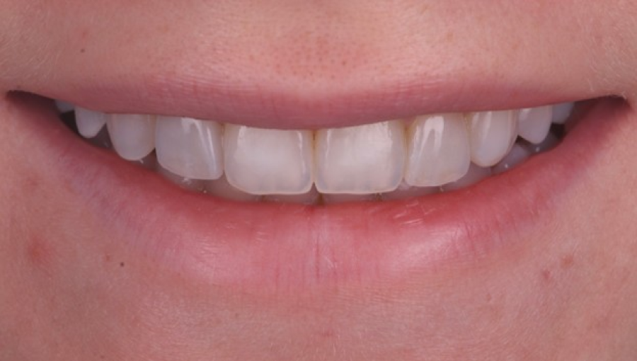 chirurgie gencives retractees Malformations dentaires : dents en grain de riz (riziforme) et anomalies de structure Dentiste Orangerie, Strasbourg | Esthétique & Implant