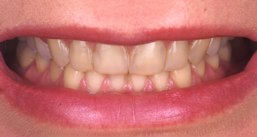 chirurgie reconstruction osseuse Érosion dentaire : l’effet des acides sur l’émail Dentiste Orangerie, Strasbourg | Esthétique & Implant