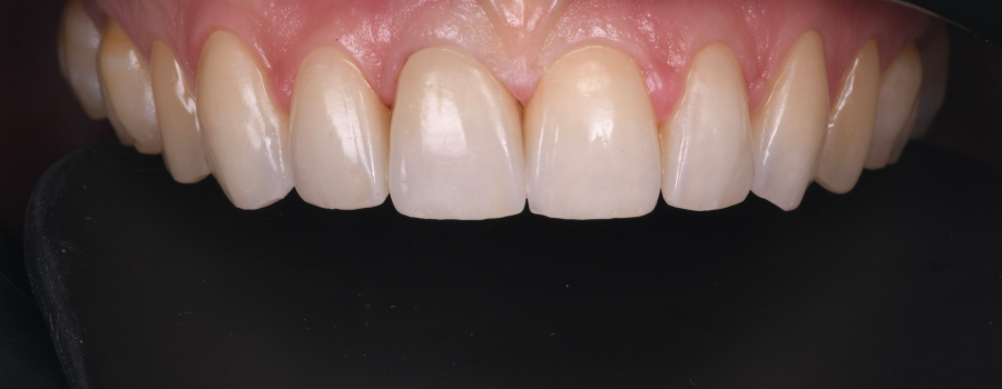 consultation dentaire specialisee Bruxisme : une usure dentaire silencieuse et destructrice Dentiste Orangerie, Strasbourg | Esthétique & Implant