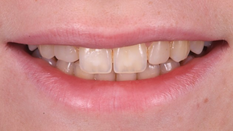 consultation esthetique sourire Malformations dentaires : dents en grain de riz (riziforme) et anomalies de structure Dentiste Orangerie, Strasbourg | Esthétique & Implant