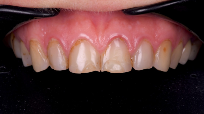 controle annuel dentaire Érosion dentaire : l’effet des acides sur l’émail Dentiste Orangerie, Strasbourg | Esthétique & Implant