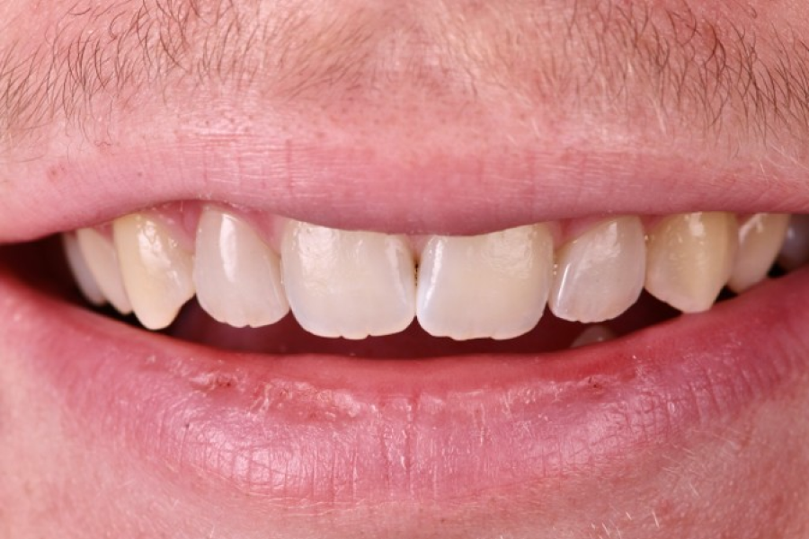 correction dentaire laser Malformations dentaires : dents en grain de riz (riziforme) et anomalies de structure Dentiste Orangerie, Strasbourg | Esthétique & Implant