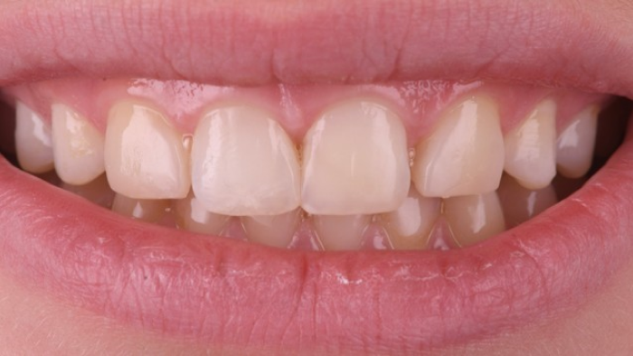 correction dents crochees correction dents crochees Agénésies dentaires : remplacer une dent absente dès la naissance Dentiste Orangerie, Strasbourg | Esthétique & Implant