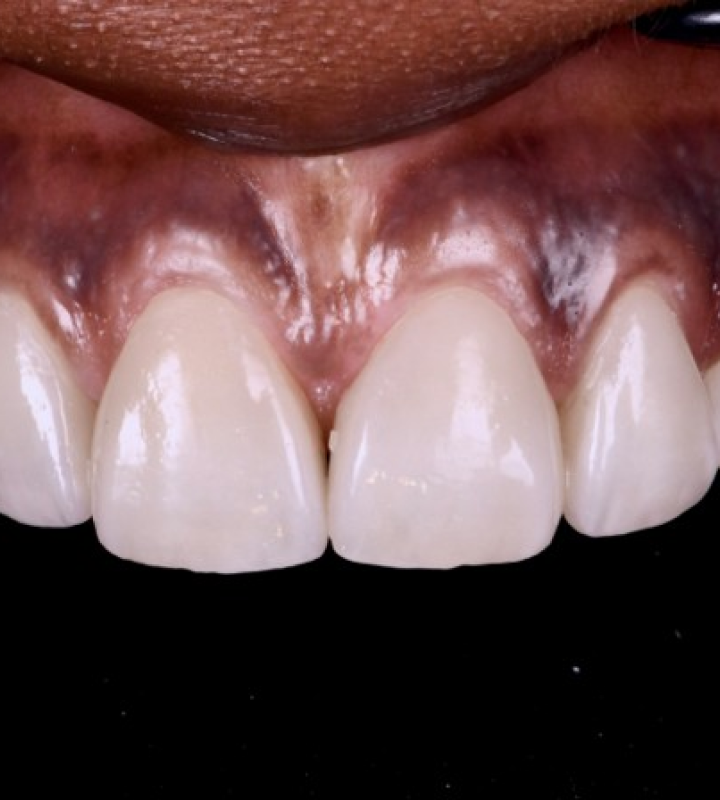 Dentiste Orangerie, Strasbourg | Esthétique & Implant taches dentaires traitement strasbourg Traitement des tâches dentaires : un sourire magnifié Dentisterie esthétique : sublimez votre sourire