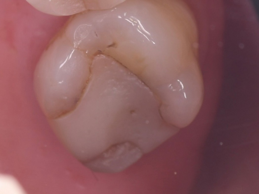 correction morsure profonde correction morsure profonde Fissures dentaires : détecter et traiter à temps Dentiste Orangerie, Strasbourg | Esthétique & Implant