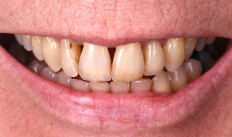 correction sourire asymetrique Parodontite et gestion esthétique d’un déchaussement Dentiste Orangerie, Strasbourg | Esthétique & Implant
