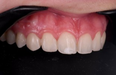 couronne ceramique sur mesure couronne ceramique sur mesure Agénésies dentaires : remplacer une dent absente dès la naissance Dentiste Orangerie, Strasbourg | Esthétique & Implant