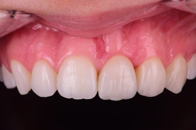 couronne dentaire personnalisee couronne dentaire personnalisee Agénésies dentaires : remplacer une dent absente dès la naissance Dentiste Orangerie, Strasbourg | Esthétique & Implant