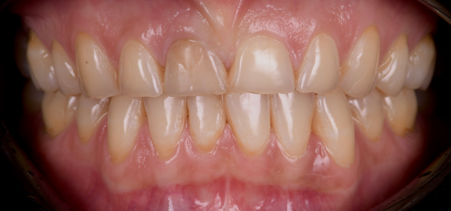 d50 3270 Bruxisme : une usure dentaire silencieuse et destructrice Dentiste Orangerie, Strasbourg | Esthétique & Implant