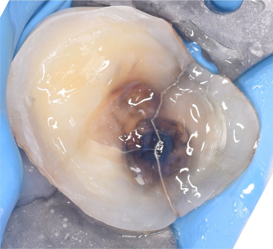 entretien prothese dentaire Fissures dentaires : détecter et traiter à temps Dentiste Orangerie, Strasbourg | Esthétique & Implant