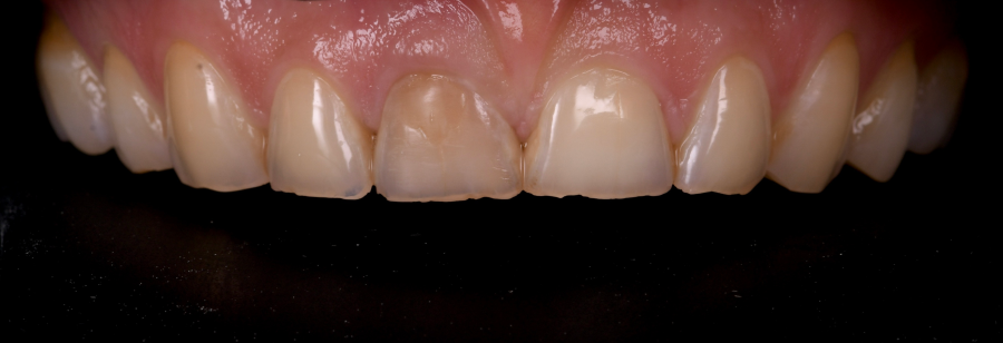 extraction dents sagesse Bruxisme : une usure dentaire silencieuse et destructrice Dentiste Orangerie, Strasbourg | Esthétique & Implant