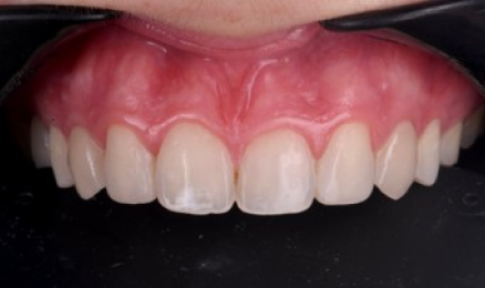 facette ceramique naturelle facette ceramique naturelle Agénésies dentaires : remplacer une dent absente dès la naissance Dentiste Orangerie, Strasbourg | Esthétique & Implant