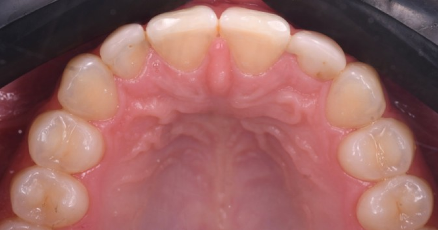 gouttiere alignement dentaire Malformations dentaires : dents en grain de riz (riziforme) et anomalies de structure Dentiste Orangerie, Strasbourg | Esthétique & Implant
