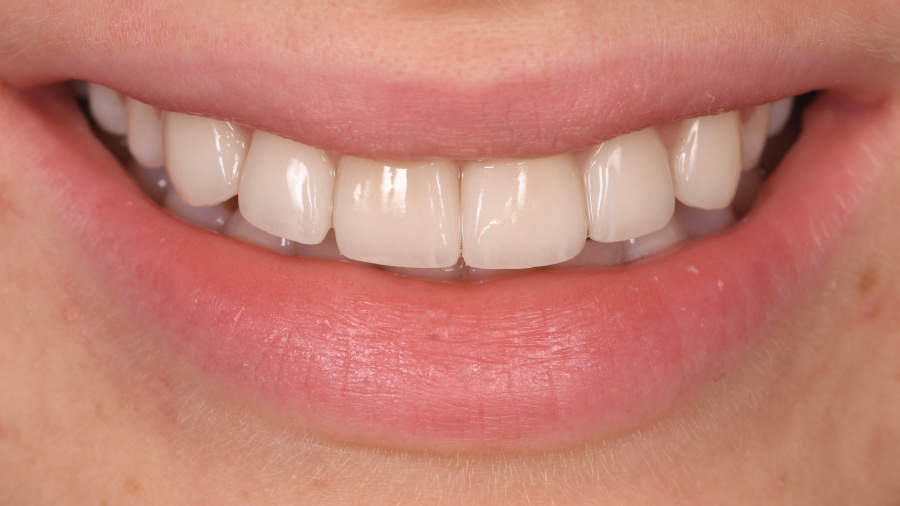 gouttiere dentaire blanchiment Malformations dentaires : dents en grain de riz (riziforme) et anomalies de structure Dentiste Orangerie, Strasbourg | Esthétique & Implant