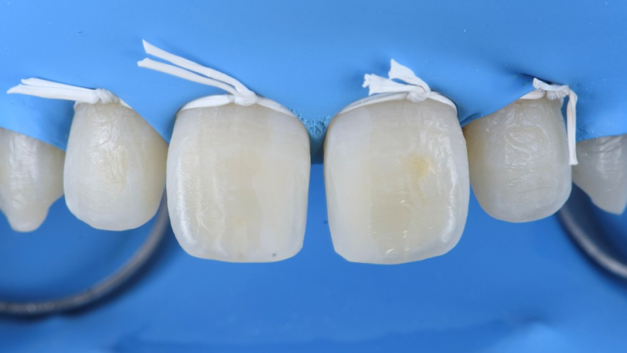 gouttiere nuit dentaire Malpositions dentaires : les diastèmes interdentaires Dentiste Orangerie, Strasbourg | Esthétique & Implant