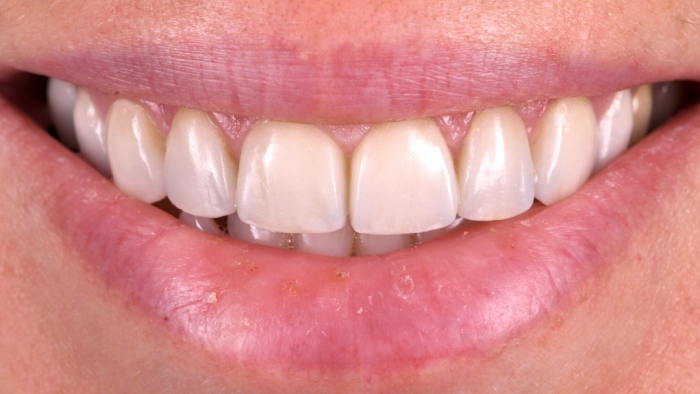 greffe gingivale esthetique Érosion dentaire : l’effet des acides sur l’émail Dentiste Orangerie, Strasbourg | Esthétique & Implant