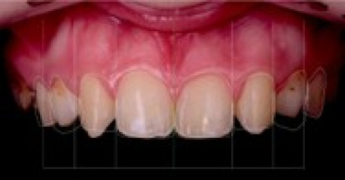 hygiene buccale enfant hygiene buccale enfant Agénésies dentaires : remplacer une dent absente dès la naissance Dentiste Orangerie, Strasbourg | Esthétique & Implant