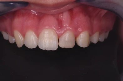 hygiene dentaire prevention caries hygiene dentaire prevention caries Agénésies dentaires : remplacer une dent absente dès la naissance Dentiste Orangerie, Strasbourg | Esthétique & Implant