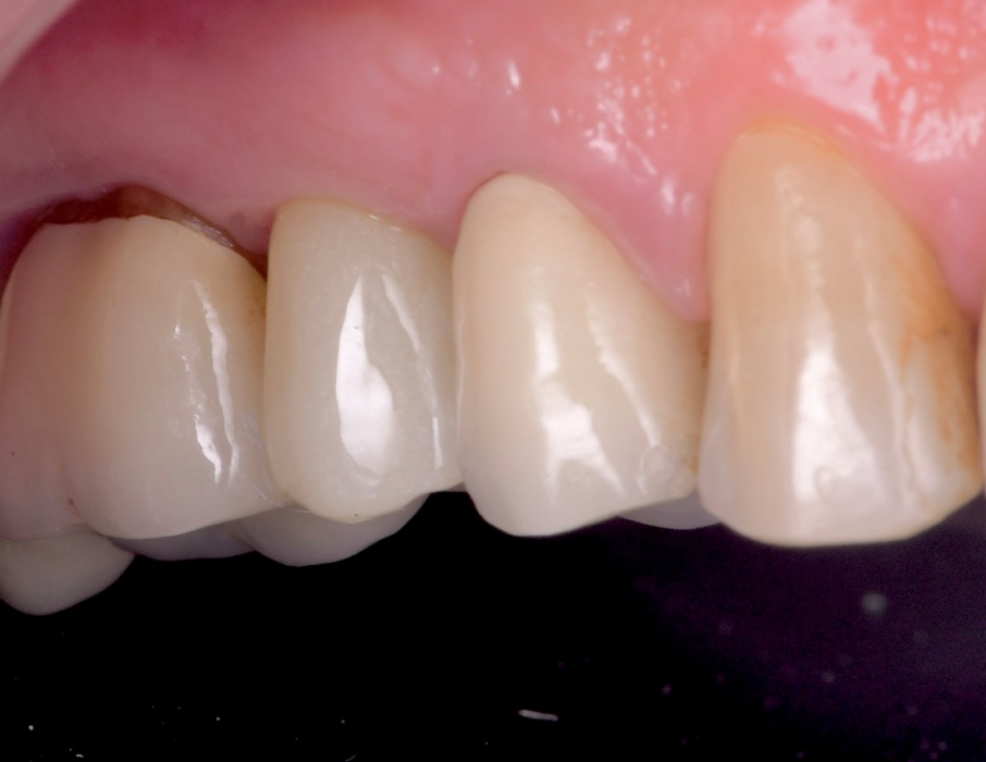 implant dentaire immediat Maintien du volume gingival après extraction dentaire : anticiper pour un résultat optimal Dentiste Orangerie, Strasbourg | Esthétique & Implant