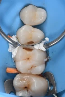 implants dentaires solution esthetique implants dentaires solution esthetique Caries, usure et érosion : préserver l’émail et la structure dentaire Dentiste Orangerie, Strasbourg | Esthétique & Implant