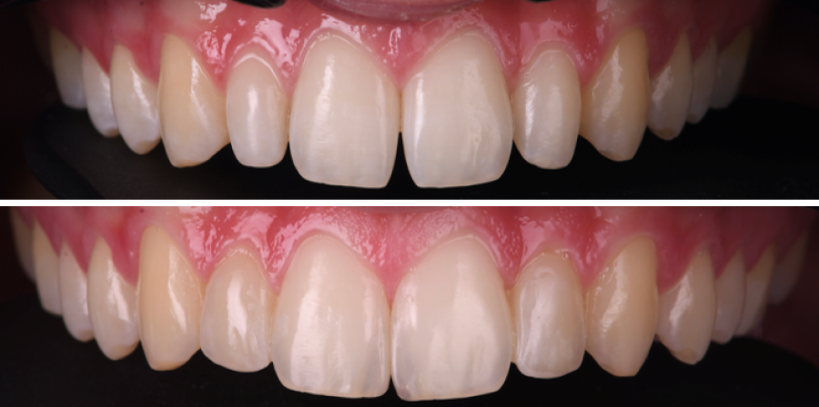 implants multiples dentaires Malformations dentaires : dents en grain de riz (riziforme) et anomalies de structure Dentiste Orangerie, Strasbourg | Esthétique & Implant