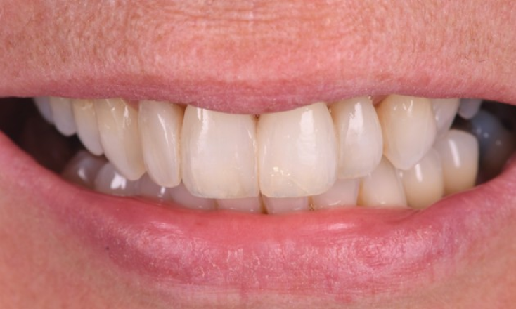 nettoyage dentaire professionnel Parodontite et gestion esthétique d’un déchaussement Dentiste Orangerie, Strasbourg | Esthétique & Implant