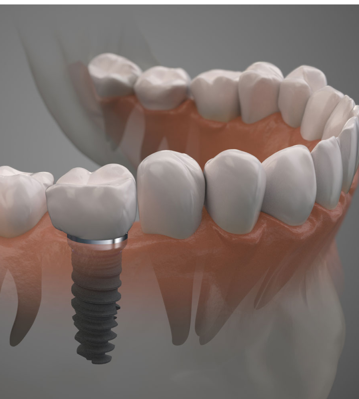 Dentiste Orangerie, Strasbourg | Esthétique & Implant taches dentaires traitement strasbourg Traitement des tâches dentaires : un sourire magnifié Dentisterie esthétique : sublimez votre sourire