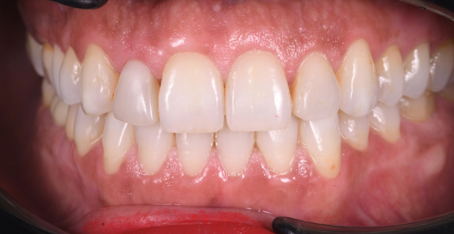 orthodontie moderne techniques Pigmentation ethnique : respecter la diversité, traiter si nécessaire Dentiste Orangerie, Strasbourg | Esthétique & Implant
