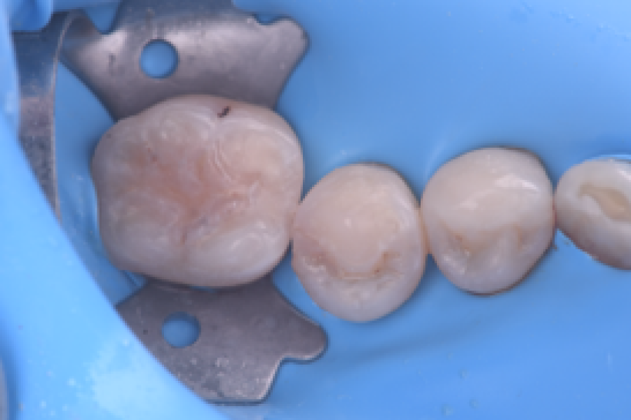 orthodontie precoce enfant Érosion dentaire : l’effet des acides sur l’émail Dentiste Orangerie, Strasbourg | Esthétique & Implant